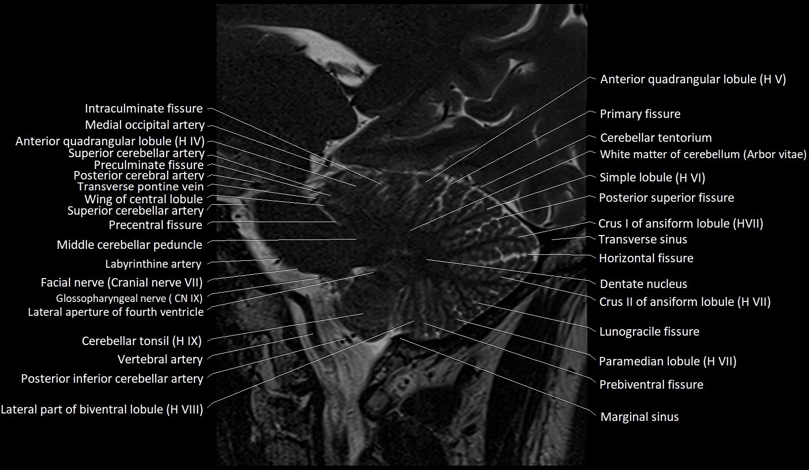 MRI Cerebellar anatomy sagittal High-resolution labelled image 23.webp
